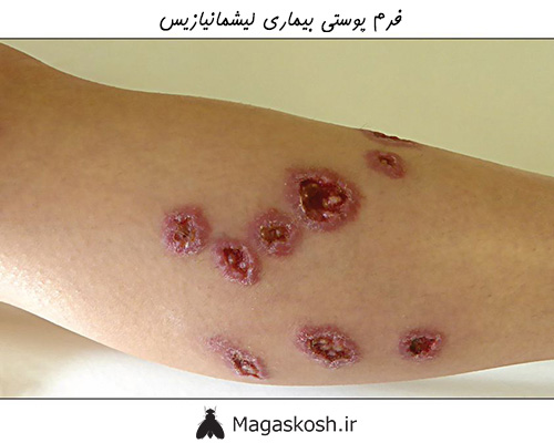 لیشمانیازیس یکی از بیماری های ناشی از مگس فاضلاب